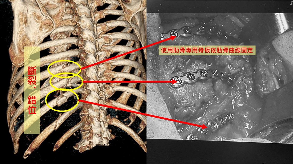 九旬翁肋骨骨折疼痛折磨 肋骨骨板固定術助早復元 3 003