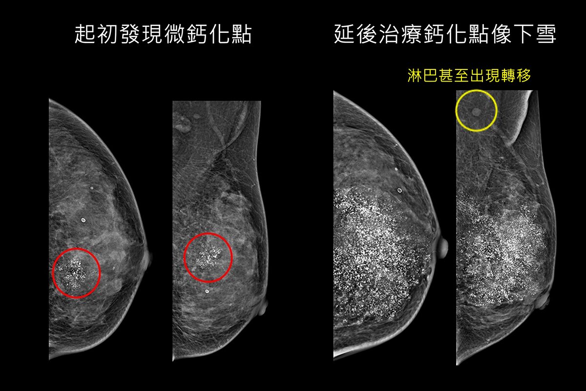 婦人接受乳房攝影篩檢發現微鈣化點，再切片確認罹患早期乳癌（左圖 ），延後治療再檢查，鈣化點如下雪並已出現淋巴轉移（右圖 ）。