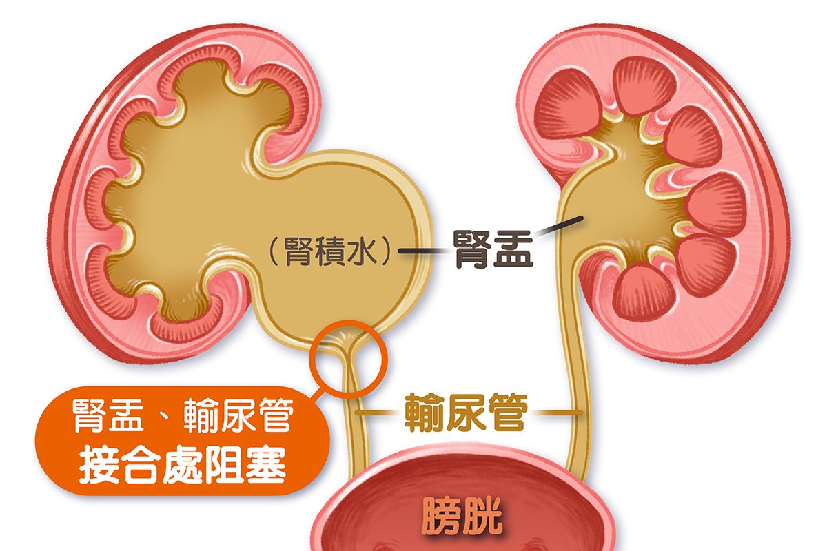 「腎盂輸尿管接合處狹窄」  導致腎水腫示意圖。