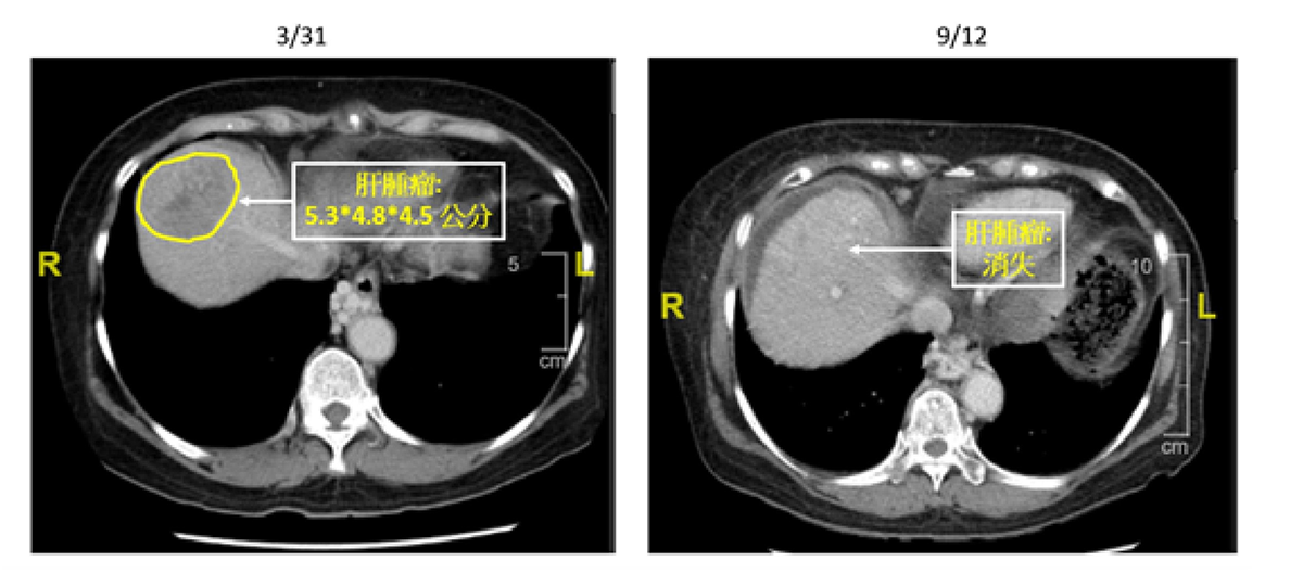 經過立體放射手術合併雷沙瓦治療，肝腫瘤消失