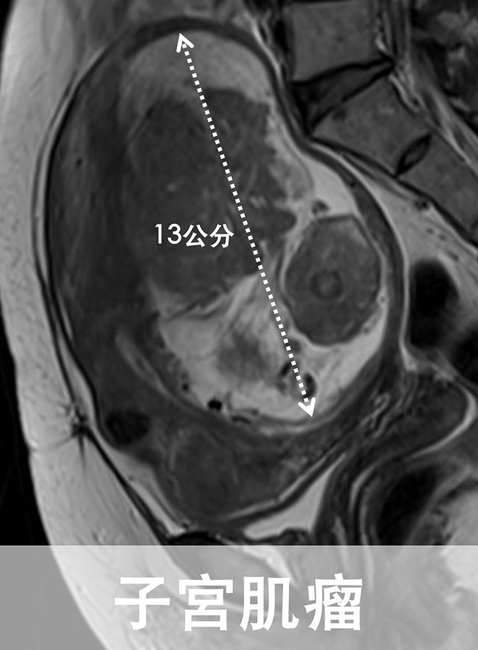 陳文欣醫師指出婦女腹中子宮肌瘤直徑長達13公分，子宮脹大到相當懷孕20週的大小