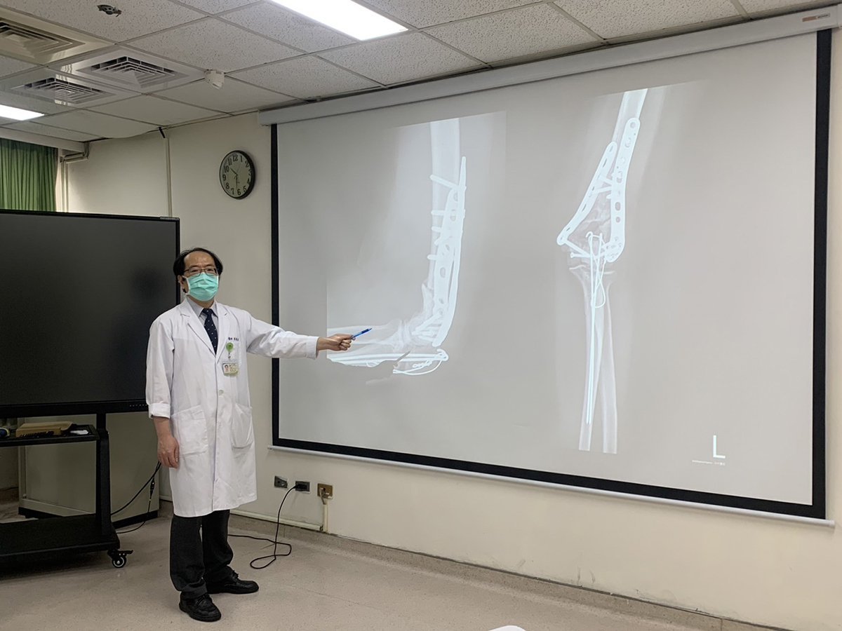 黃敏旭主任幫她進行X光與3D立體攝影後，發現是遠左手端肱骨粉碎性骨折