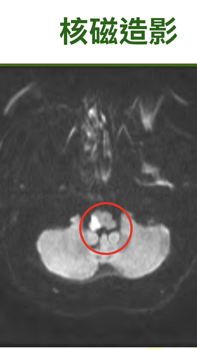 寒流害走路不穩 民眾輕忽疲倦感恐錯過中風黃金治療期 2 S 5087281