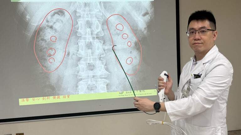 追劇忘喝水、半年三度腎結石 婦人雙腎如「葡萄乾麵包」 醫:夏季結石患者增2至3倍 3 S 11190283 0
