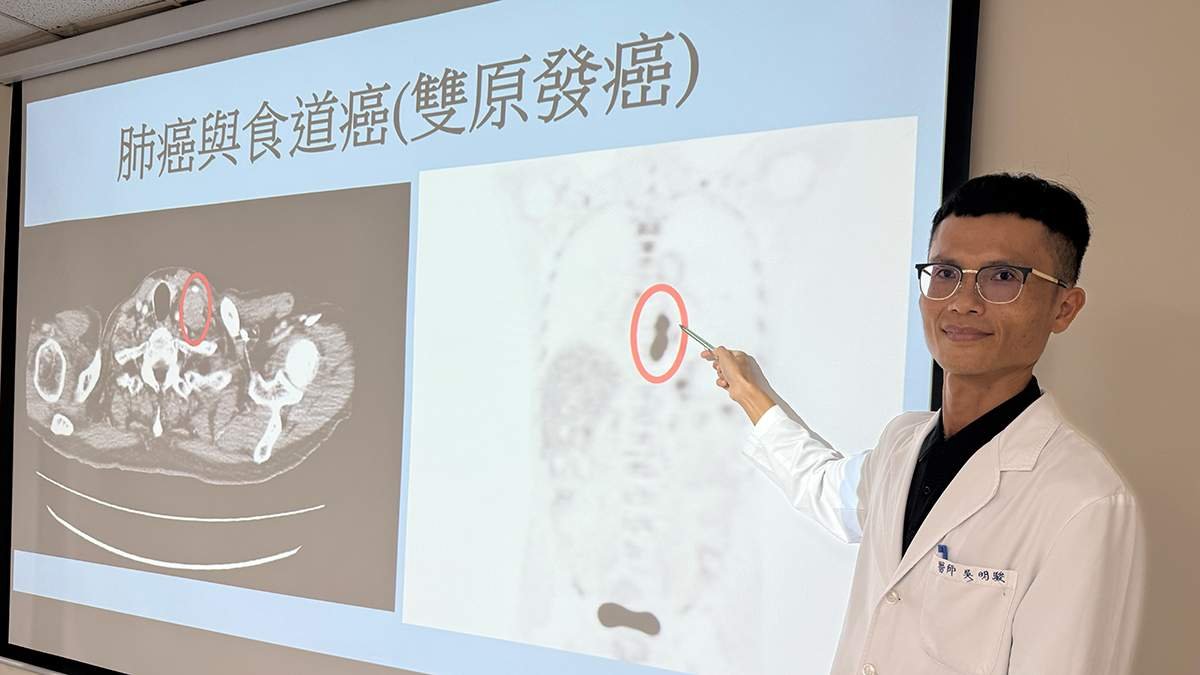 戒菸戒酒仍難逃雙癌 68歲企業主肺癌8年後再罹食道癌 醫籲高風險族群定期胃鏡追蹤 1 S 11395164