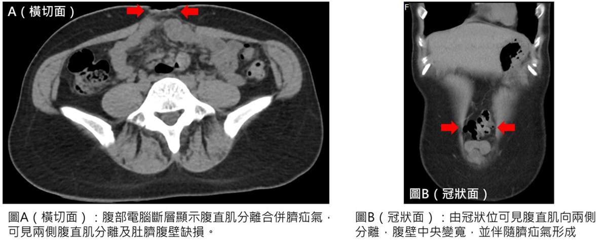 產後肚子消不下去竟是腹直肌分離 達文西手術助32歲媽媽重拾核心力量 2 line oa chat 260707 141907